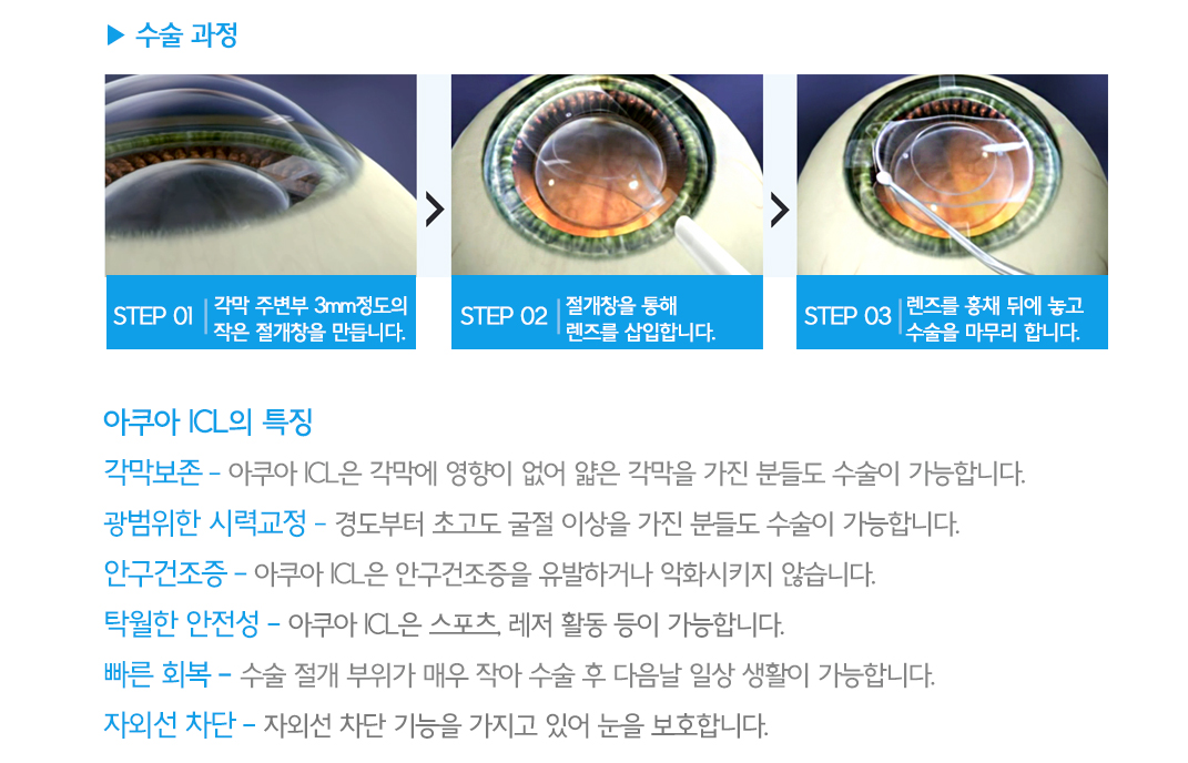 안내렌즈삽입술